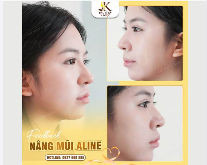 Đón Tết bằng dáng mũi chuẩn không cần chỉnh