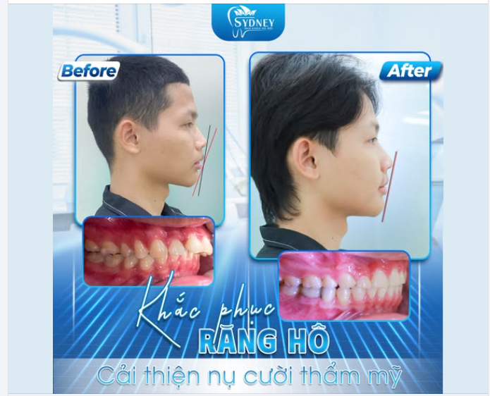 KHẮC PHỤC RĂNG HÔ - CẢI THIỆN THẨM MỸ NỤ CƯỜI