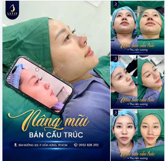 BÍ QUYẾT MŨI THON - MẶT THANH TÚ: TẠM BIỆT SỐNG MŨI TO BÈ