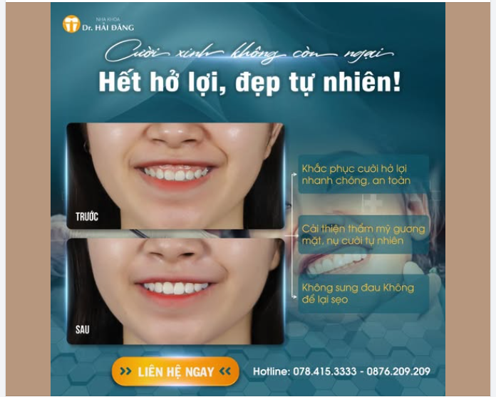 CƯỜI XINH KHÔNG CÒN NGẠI – HẾT HỞ LỢI, ĐẸP TỰ NHIÊN