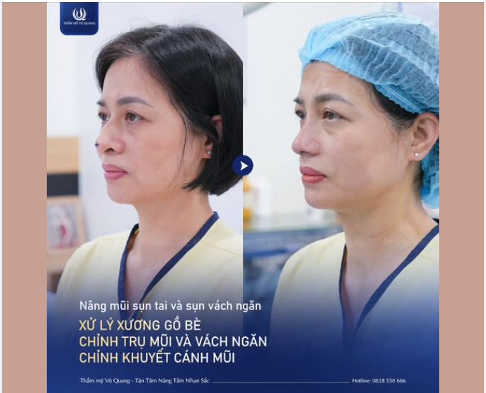 NÂNG MŨI TỰ THÂN – 60 PHÚT TÁI TẠO DIỆN MẠO HOÀN HẢO