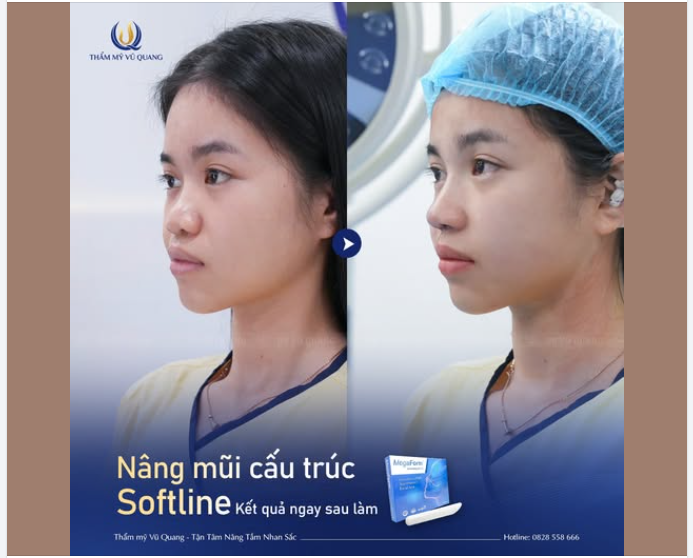 GÓC NGHIÊNG CỰC PHẨM – DÁNG MŨI SOFTLINE "THĂNG HẠNG" NHAN SẮC NGAY SAU LÀM!