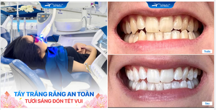 Giải mã tất tần tật băn khoăn về tẩy trắng răng dịp cận Tết
