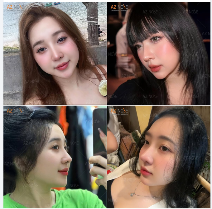 Không còn lo sự "thất thường" vì tiêm filler