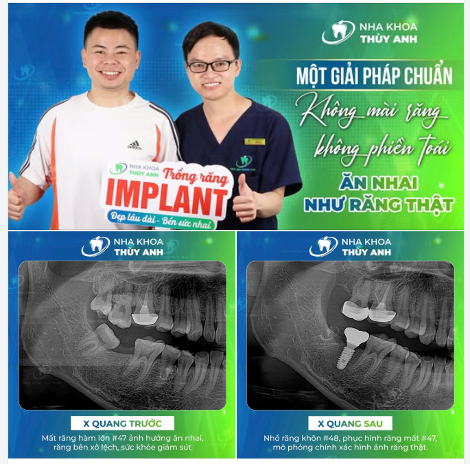 TẾT ĐẾN GẦN, MẤT RĂNG HÀM NHAI – LÀM SAO ĐỂ ĂN NHAI NHANH, BỀN, VỮNG?