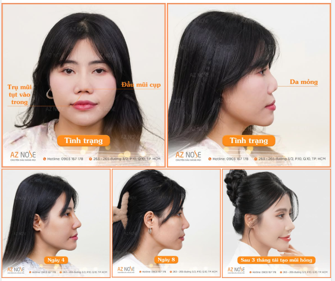 Khắc phục đầu mũi cụp, trụ mũi tụt vào trong cho khách hàng đến từ KhánhHoà