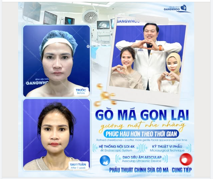 GÒ MÁ GỌN LẠI – GƯƠNG MẶT NHẸ NHÀNG, PHÚC HẬU HƠN THEO THỜI GIAN