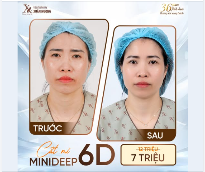 LÀM ĐẸP THẢ GA, KHÔNG LO VỀ GIÁ  CẮT MÍ MINIDEEP 6D GIẢM CỰC SÂU, HIỆU QUẢ CỰC SỐC!
