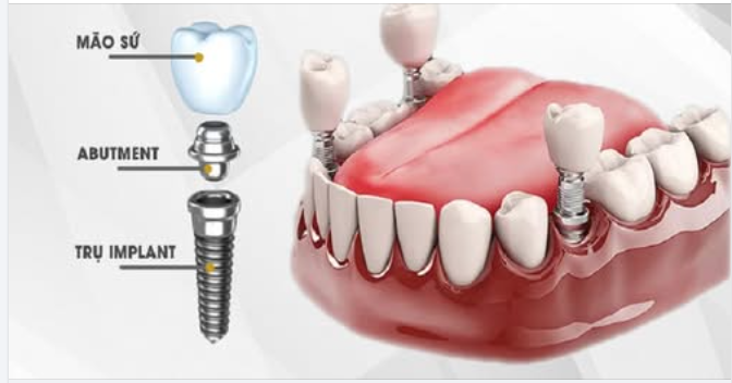 Tìm hiểu về kỹ thuật cấy ghép Implant