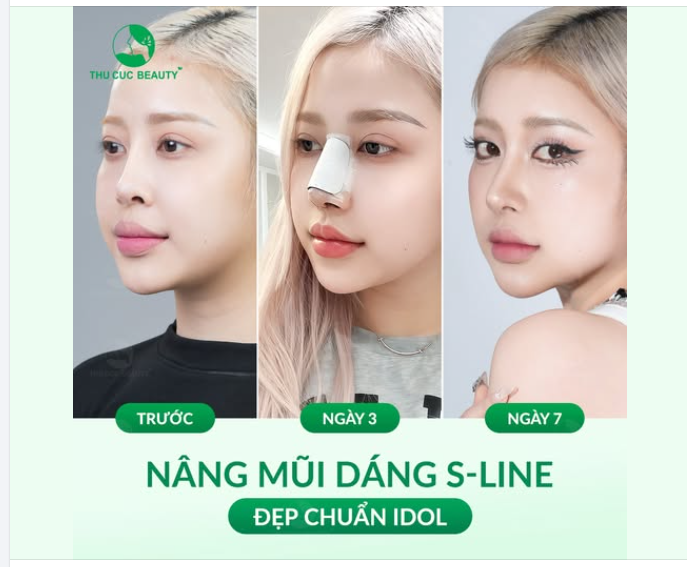 Loại bỏ mũi thấp, lệch trụ Có ngay sống mũi cao thanh thoát