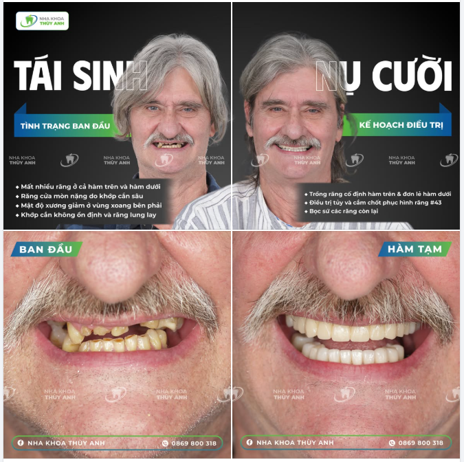 TÁI SINH HÀM RĂNG XUỐNG CẤP NẶNG | KHÁCH HÀNG NAM NGƯỜI ÚC