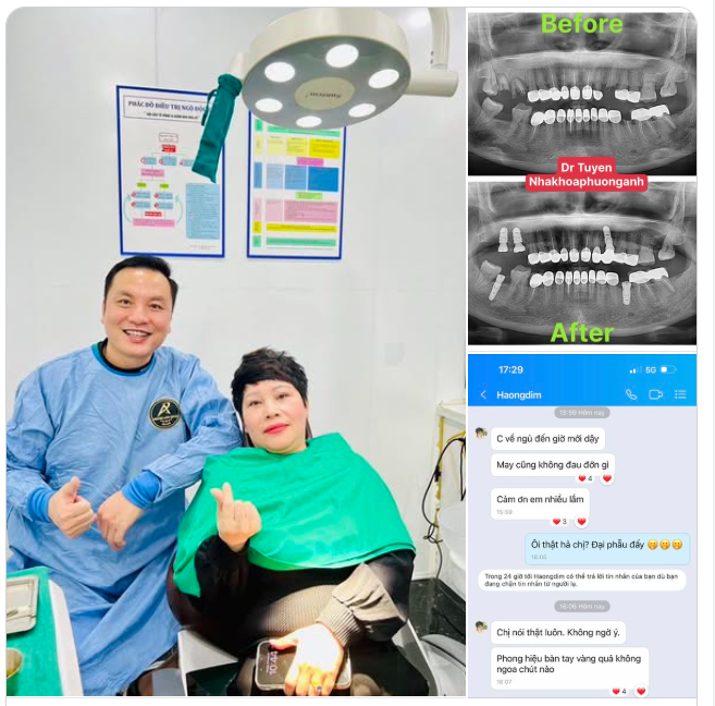Ưu điểm của cấy ghép Implant tức thì (đặt Implant ngay sau khi nhổ răng) gồm nhiều lợi ích quan trọng so với cấy ghép trì hoãn: