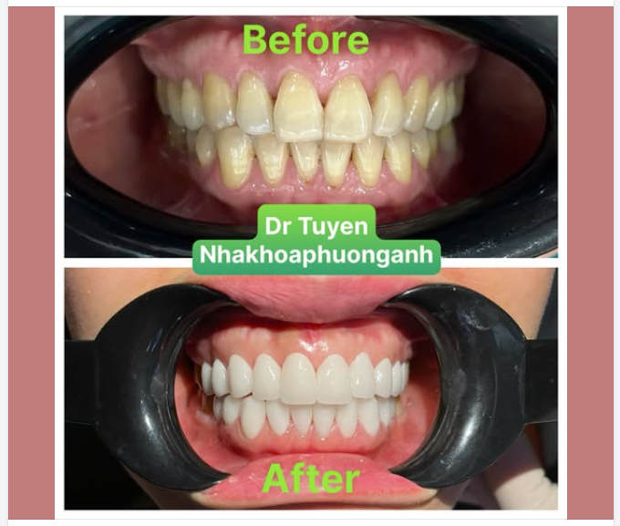 Bọc răng sứ giữ được bao lâu và hướng dẫn chăm sóc sau bọc răng