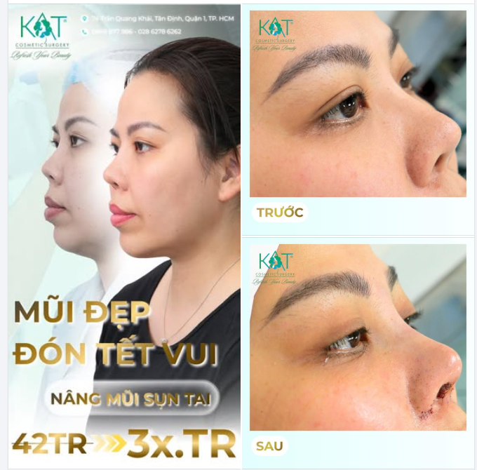 MŨI ĐẸP ĐÓN TẾT – ƯU ĐÃI CHỈ CÓ MÙA NÀY