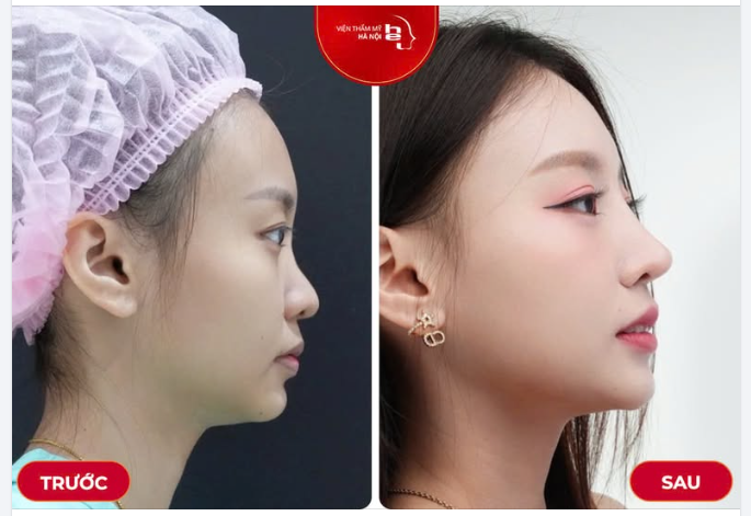 Thăng hạng nhan sắc – Chuẩn dáng mũi đẹp chỉ trong 45 phút