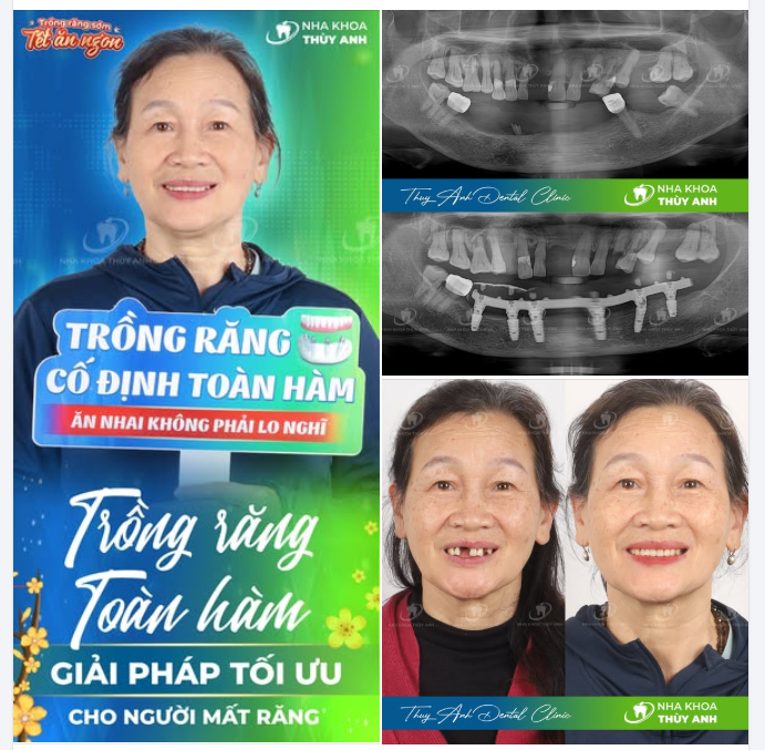 KHÔNG ĐỂ TẾT NÀY MẸ VẪN KHỔ VÌ HÀM RĂNG HỎNG, CON ĐƯA MẸ TỚI THÙY ANH TRỒNG IMPLANT