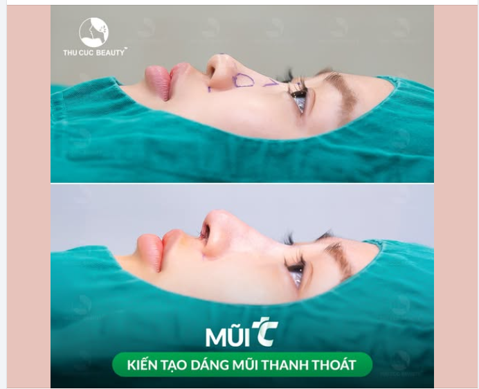 Dáng mũi thanh thoát - nâng tầm nhan sắc nhờ Mũi TC