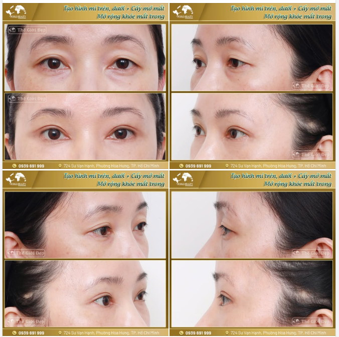 Quý Cô U40 trẻ hóa đôi mắt bằng bộ 3 tạo hình toàn diện