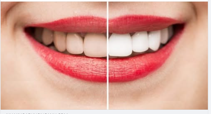 Nguyên nhân đổi màu răng sứ