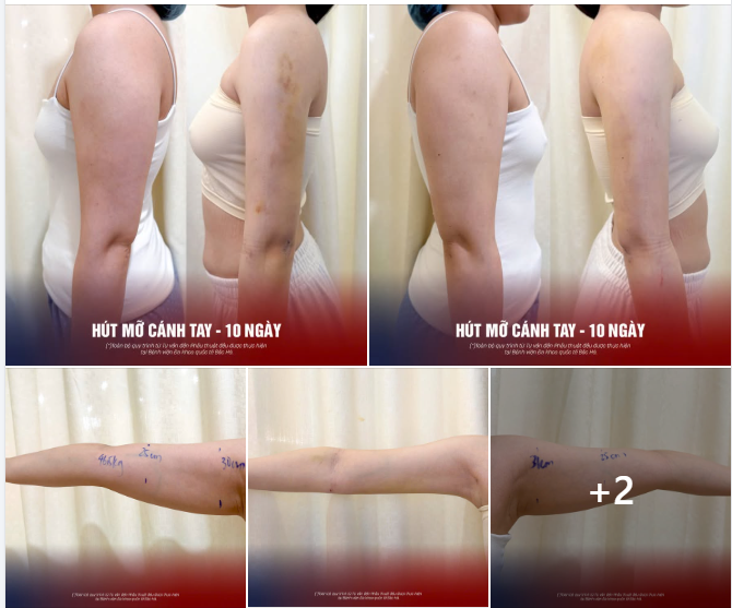 Hình ảnh trước – sau 10 ngày hút mỡ cánh tay bên dưới là câu trả lời rõ nhất.