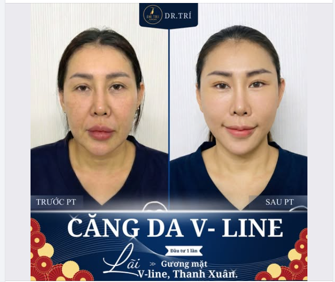 ĐỪNG ĐỂ LÃO HÓA "CƯỚP" ĐI THANH XUÂN – LẤY LẠI V-LINE CHỈ SAU 1 LẦN!