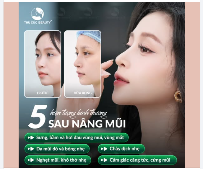 5 HIỆN TƯỢNG BÌNH THƯỜNG SAU NÂNG MŨI