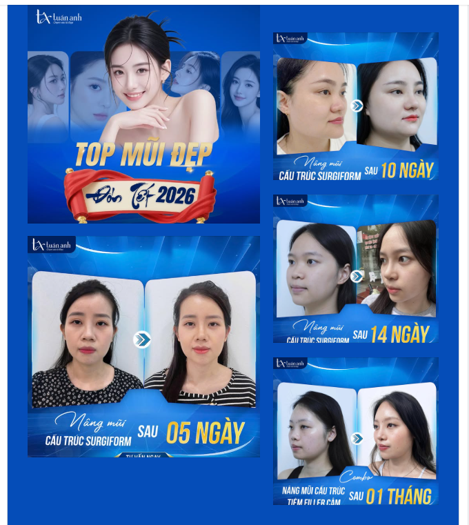 ĐIỂM DANH MŨI XINH ĐÓN TẾT 2026 TẠI THẨM MỸ TUẤN ANH