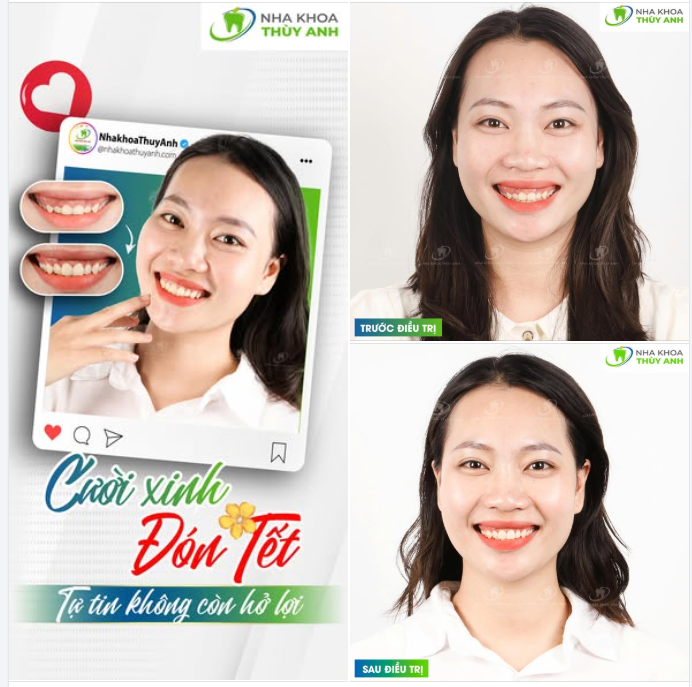 LÀM SỚM – ĐẸP SỚM  CHỮA HỞ LỢI TRƯỚC TẾT, TỰ TIN CƯỜI DUYÊN SUỐT XUÂN