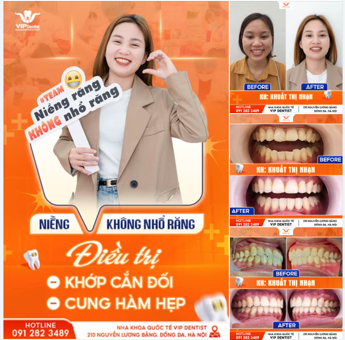 CẬP NHẬT PHIÊN BẢN MỚI CHO NỤ CƯỜI SAU ĐIỀU TRỊ KHỚP CẮN ĐỐI, CUNG HÀM HẸP