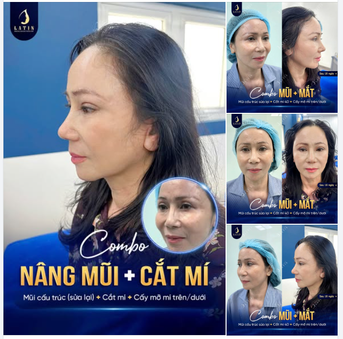 HỒI XUÂN 10 TUỔI: COMBO "MẮT BIẾT CƯỜI - MŨI THANH TÚ" CHỈ SAU 10 NGÀY