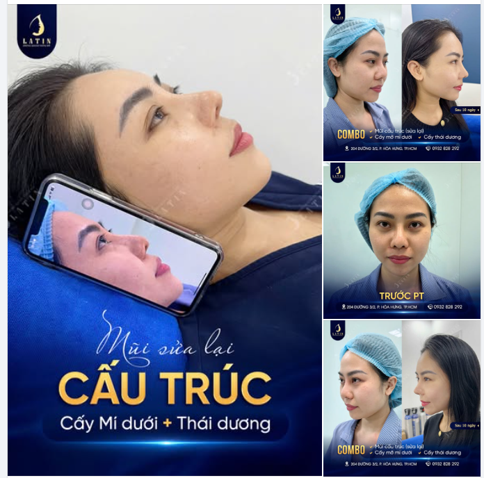 Cận cảnh sự thay đổi "không góc chết" sau 10 ngày của khách hàng thực tế sau khi thực hiện combo Mũi cấu trúc sửa lại và Cấy mỡ mặt:
