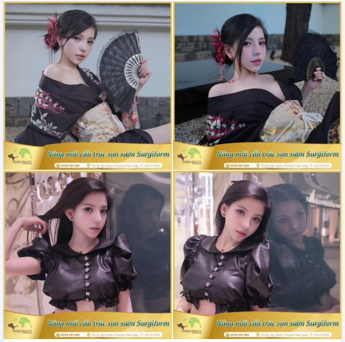 Dám sửa lại lần 2 và nhận về dáng mũi “đỉnh visual” ngoài mong đợi