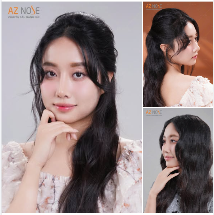 Tự tin hơn, thần thái hơn sau 4 tháng nâng mũi