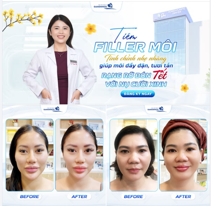 TIÊM FILLER MÔI  Tinh chỉnh nhẹ nhàng, môi căng đầy tự nhiên