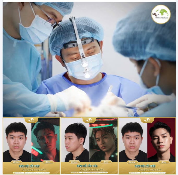 Nâng mũi cấu trúc nam – công thức thăng hạng visual cho nam giới