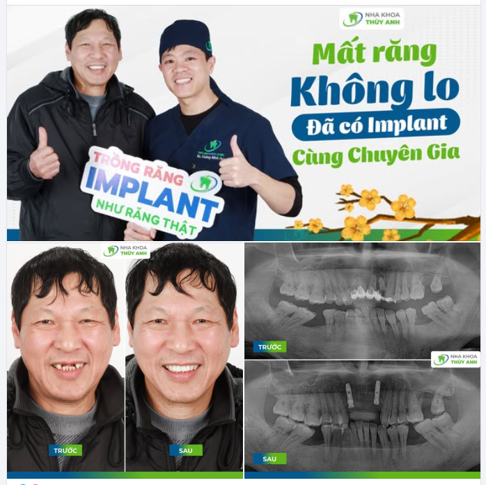 NỤ CƯỜI MỚI, ĐÓN TẾT PHƠI PHỚI NHỜ TRỒNG RĂNG IMPLANT