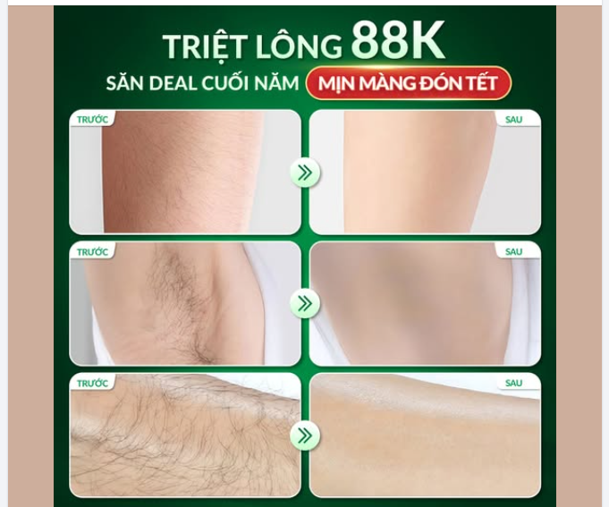 TRIỆT LÔNG 88K - CHỈ TRONG 1 LIỆU TRÌNH