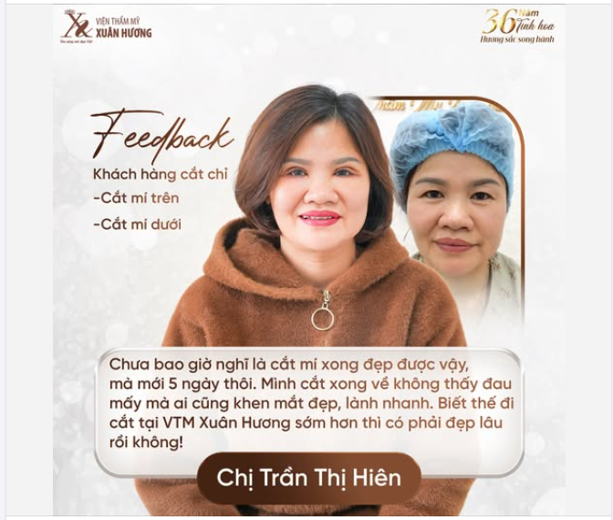 "5 NGÀY CẮT CHỈ MÀ ĐẸP QUÁ!" - FEEDBACK CHÂN THẬT NHẤT CỦA KHÁCH HÀNG SAU KHI THỰC HIỆN COMBO CẮT MÍ TRÊN DƯỚI