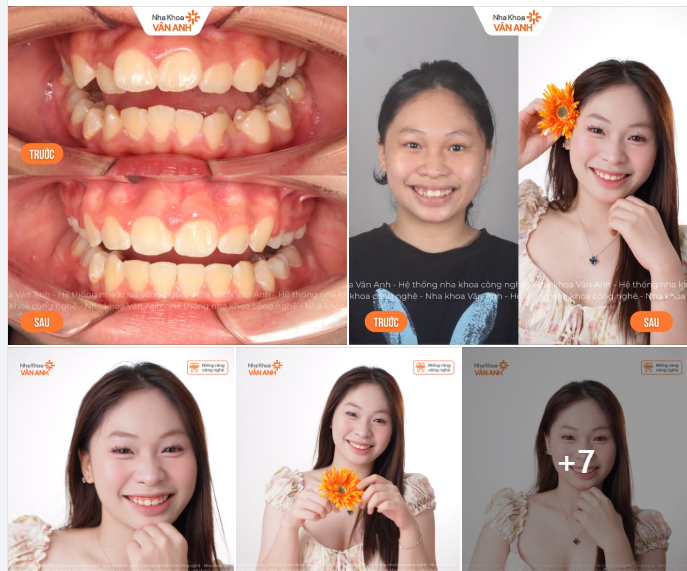 Niềng răng thời điểm vàng - Tặng con sự tự tin, tặng con tương lai sáng