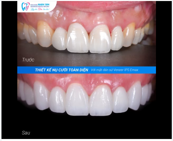 THIẾT KẾ NỤ CƯỜI RIÊNG VỚI MẶT DÁN SỨ IPS E.MAX