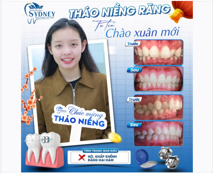 THÁO NIỀNG RĂNG - TỰ TIN CHÀO XUÂN MỚI