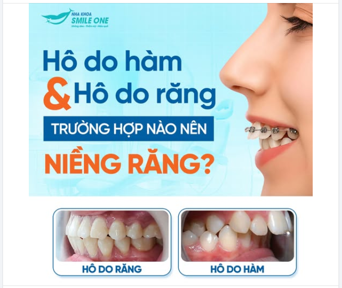 HÔ DO HÀM HÔ DO RĂNG – TRƯỜNG HỢP NÀO NÊN NIỀNG RĂNG?