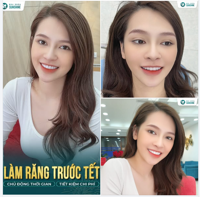 LÀM RĂNG SỨ – TẶNG RĂNG SỨ GIÁ KHÔNG ĐỔI