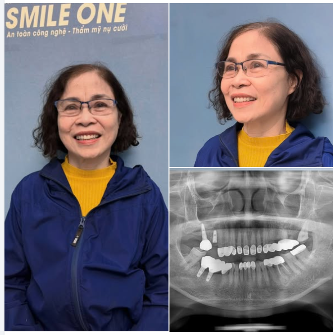 Khách hàng đã trồng răng được 11 năm và quay lại làm thêm răng sứ