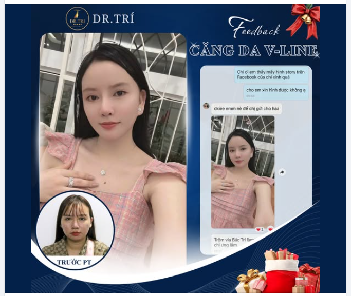 TẠM BIỆT GƯƠNG MẶT CHẢY XỆ – SỞ HỮU GÓC NGHIÊNG V-LINE "VẠN NGƯỜI MÊ"!