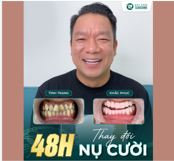 KHÔNG CHỈ PHÁI NỮ, PHÁI NAM CŨNG NÊN LÀM RĂNG KHI GẶP KHUYẾT ĐIỂM