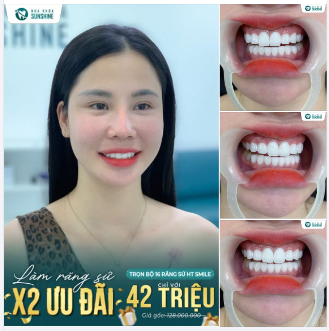 CHỈ 42 TRIỆU – TRỌN BỘ 16 RĂNG SỨ HT SMILE