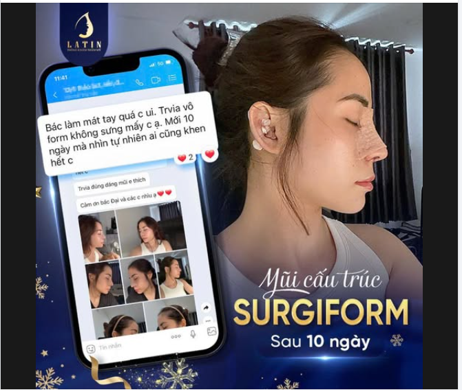 MŨI CẤU TRÚC SURGIFORM: FORM GOM "NÉT CĂNG" CHỈ SAU 10 NGÀY