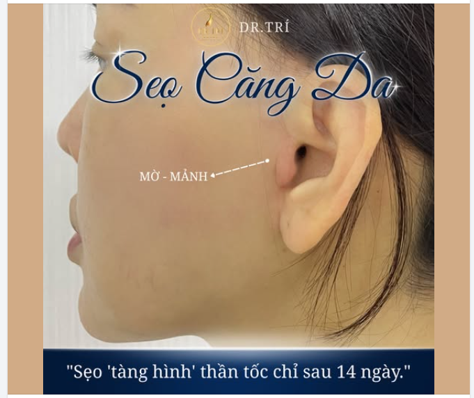 SỢ SẸO LỒI, SẸO CHÂN RẾT SAU CĂNG DA – MUỐN TRẺ ĐẸP NHƯNG NGẠI "DẤU VẾT"?