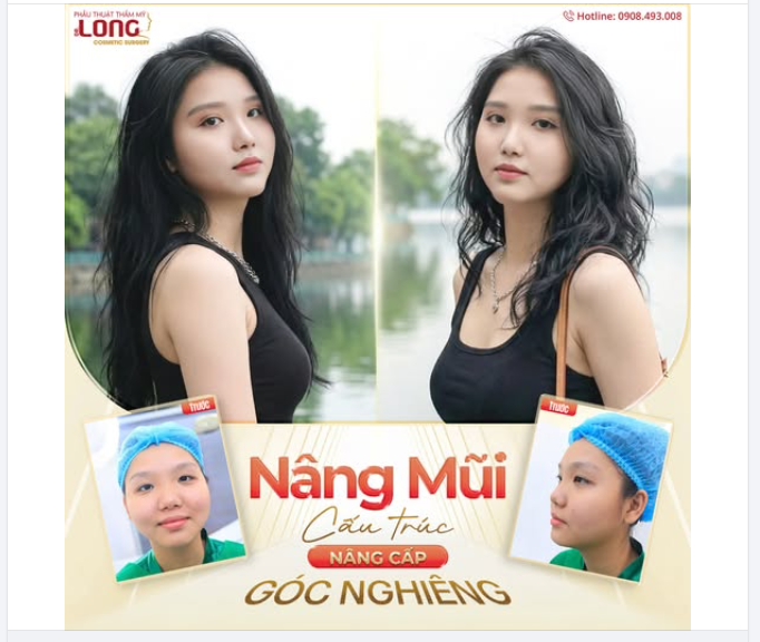 PHIÊN BẢN “MỚI” CỦA KHÁCH HÀNG SAU 1 NĂM ĐƯỢC BÁC SĨ LONG NÂNG MŨI